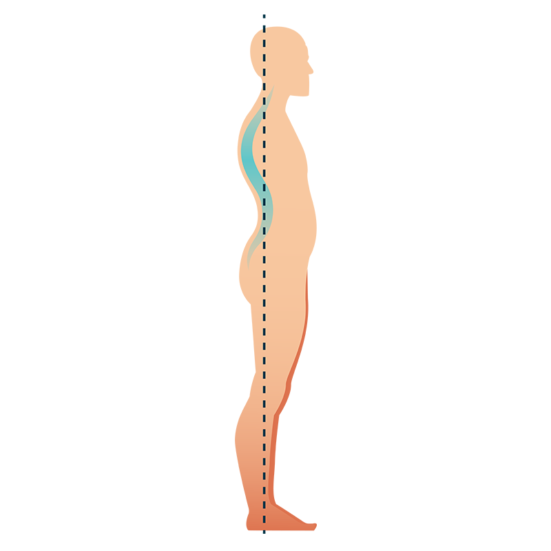 Image showing kyphosis posture.